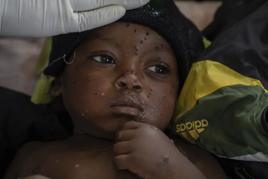 Mpox is killing again. It didn’t have to be this way.