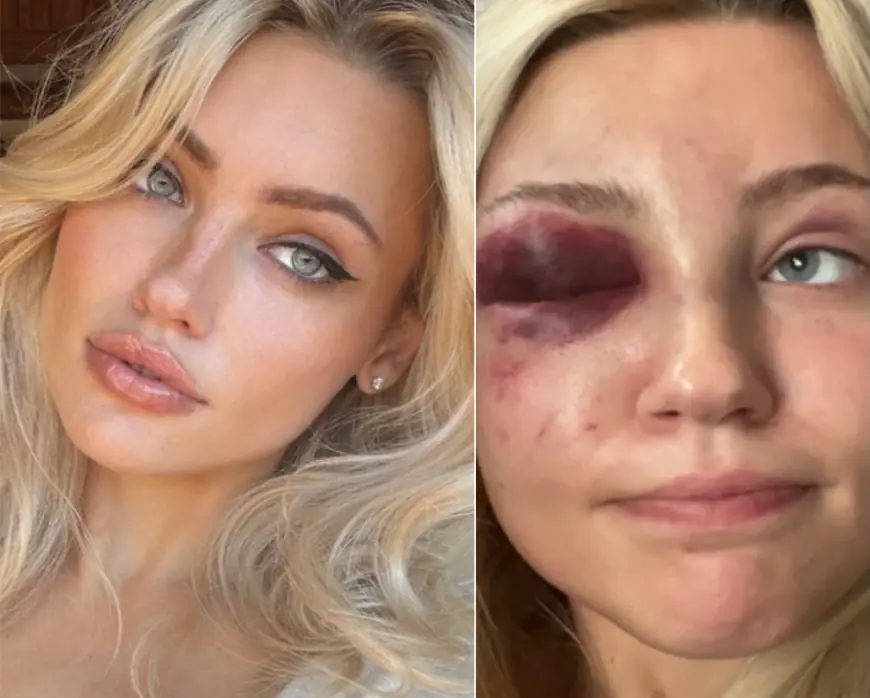 Model savagely beaten, turned into ‘sex slave’ by sicko NYC plastic surgeon — who performed procedure without anesthesia to cover up his abuse: lawsuit