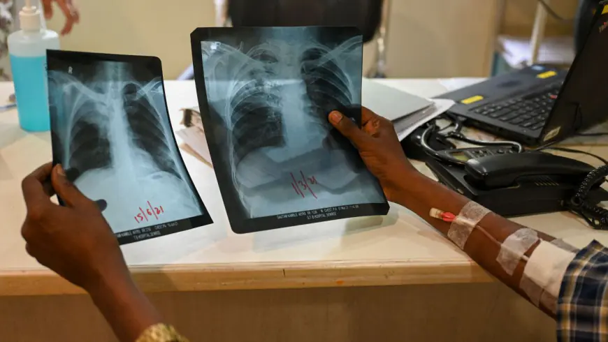 TB reclaims title of deadliest infectious disease. That's an 'outrage' says WHO