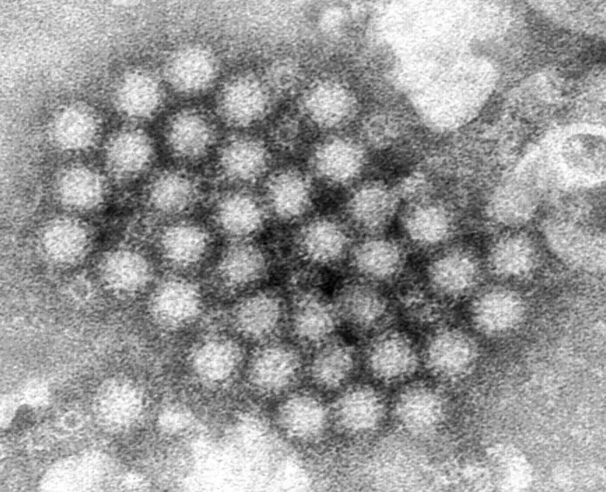 Minnesota health officials warn of rising number of norovirus outbreaks